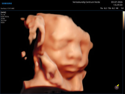Standaard 3D/4D echo