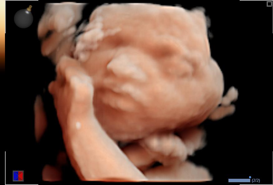 Standaard 3D/4D echo